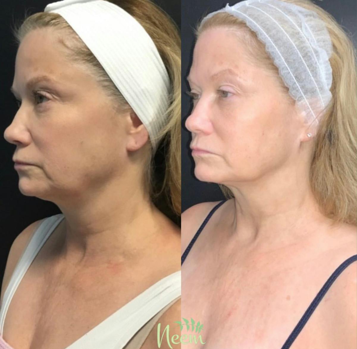 Face Before & After Gallery - Patient 962183 - Image 4