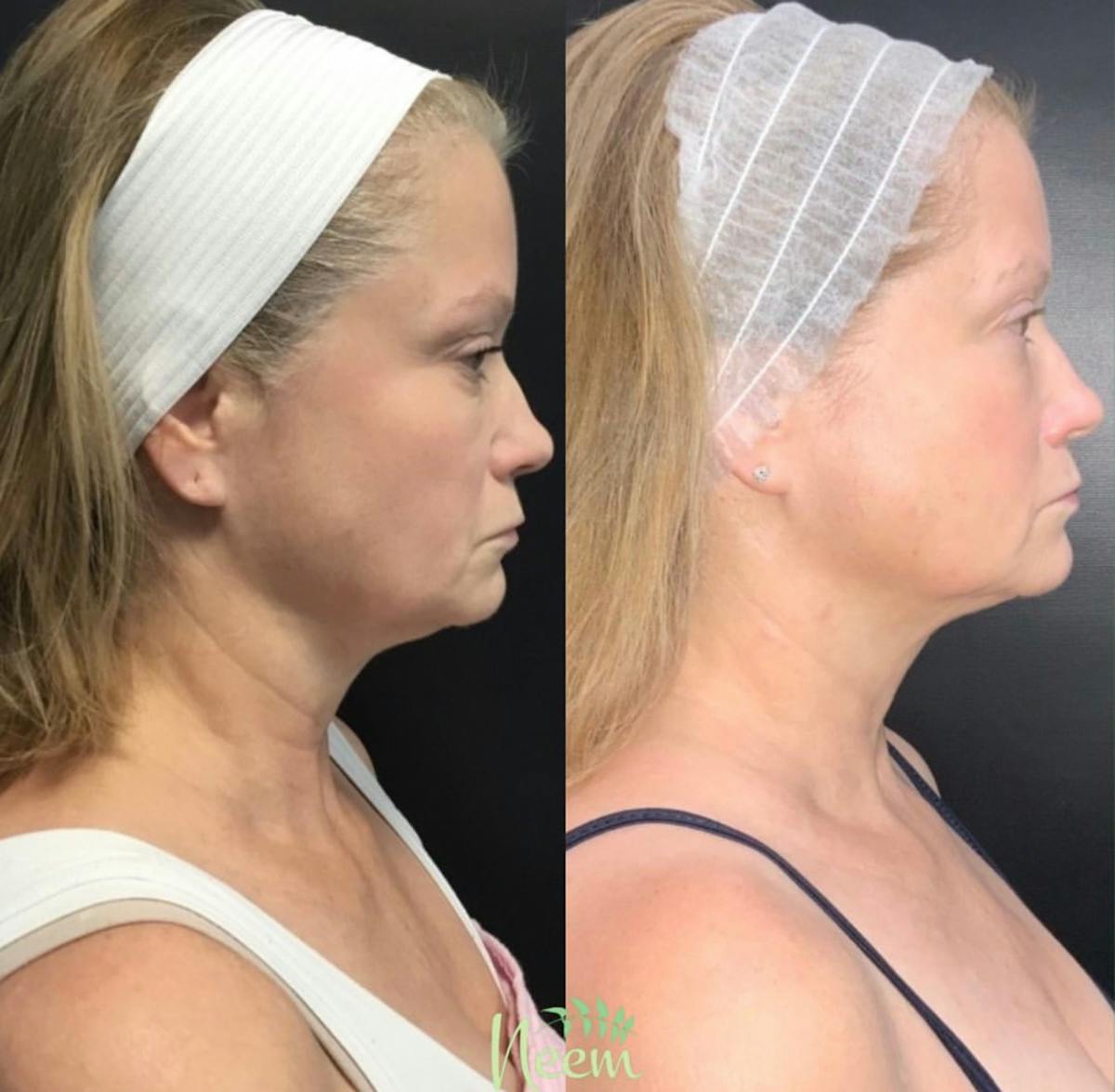 Face Before & After Gallery - Patient 962183 - Image 3