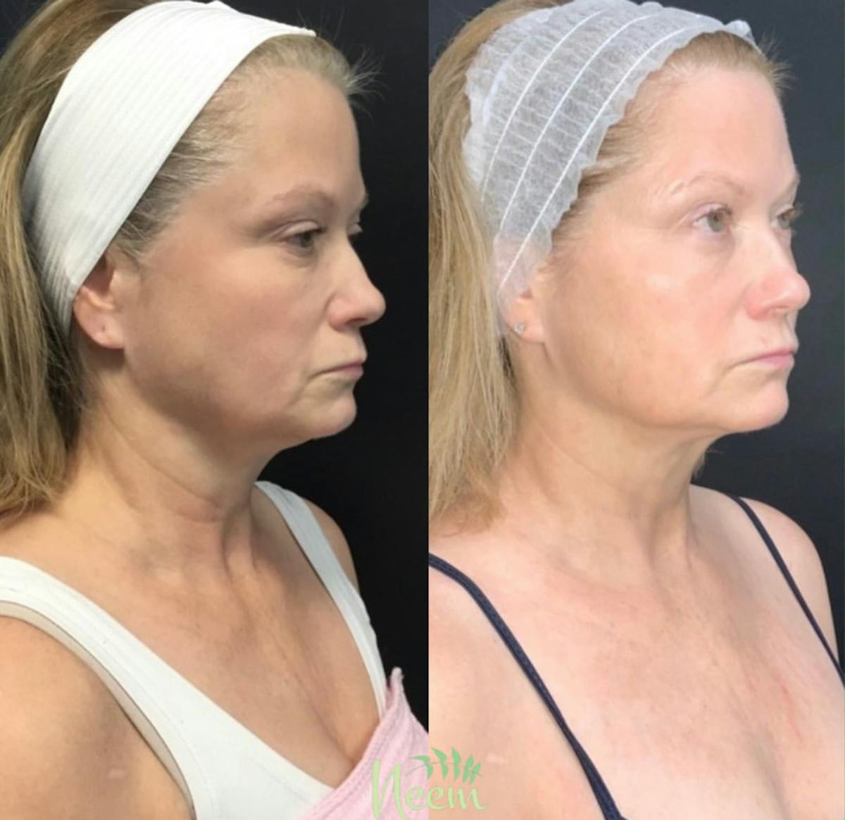 Face Before & After Gallery - Patient 962183 - Image 2
