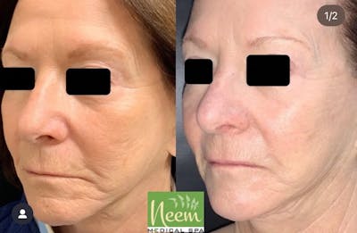Face Before & After Gallery - Patient 151243 - Image 1