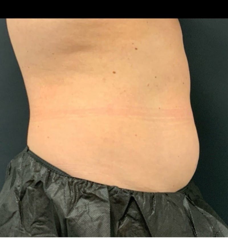 Body Before & After Gallery - Patient 153430 - Image 3