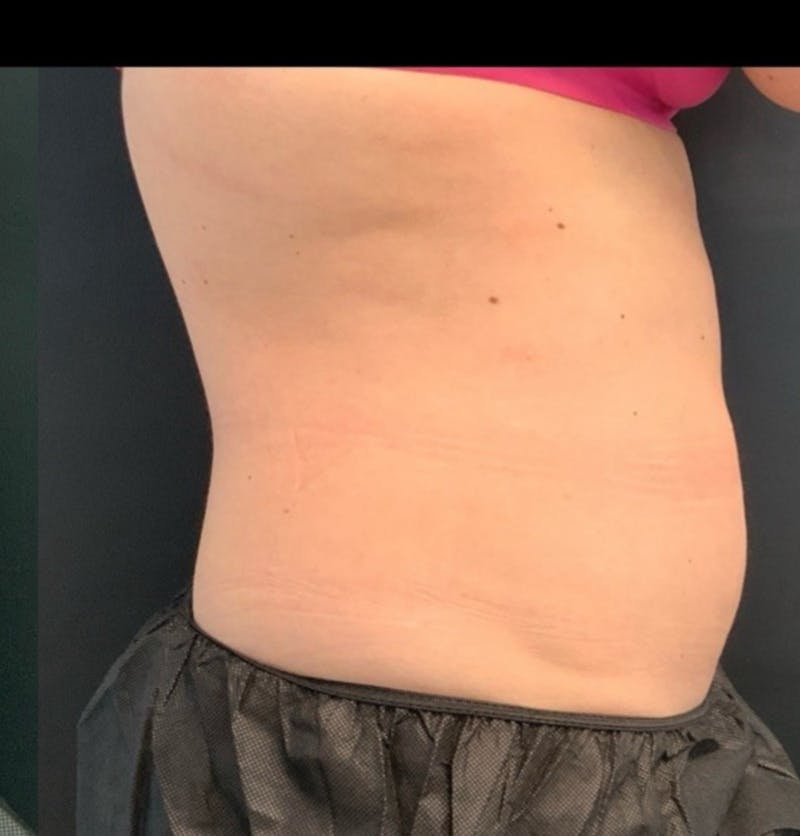 Body Before & After Gallery - Patient 153430 - Image 4