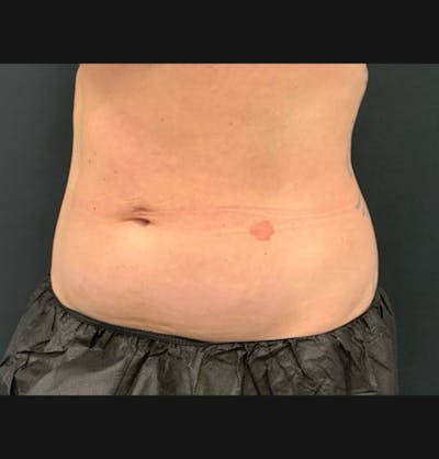 Body Before & After Gallery - Patient 153430 - Image 1