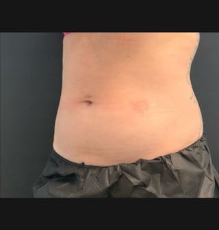 Body Before & After Gallery - Patient 153430 - Image 2