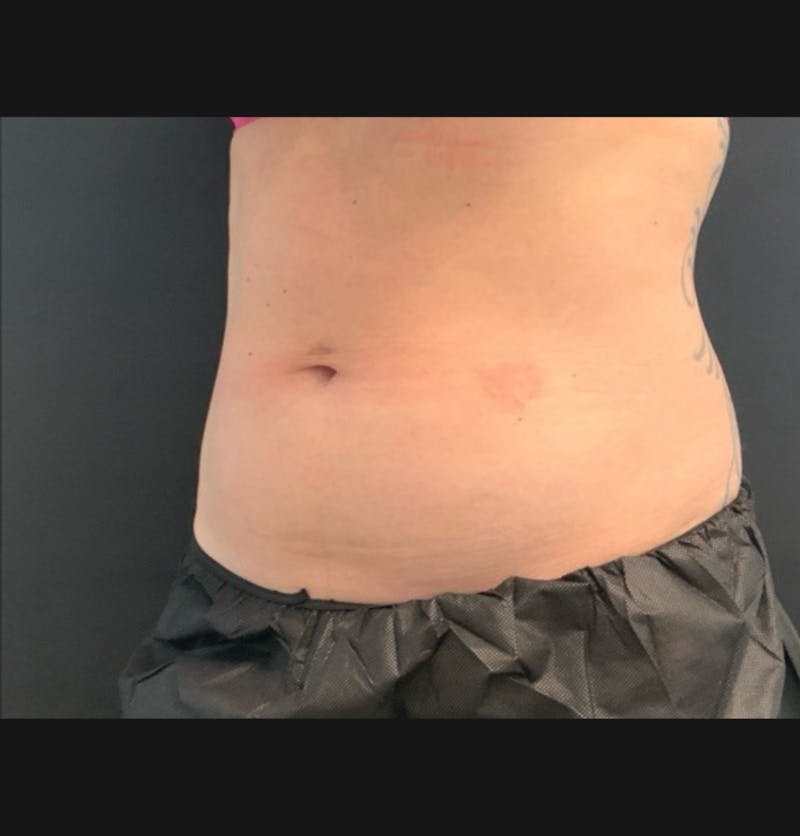 Body Before & After Gallery - Patient 153430 - Image 2