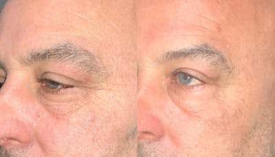 Face Before & After Gallery - Patient 322917 - Image 1
