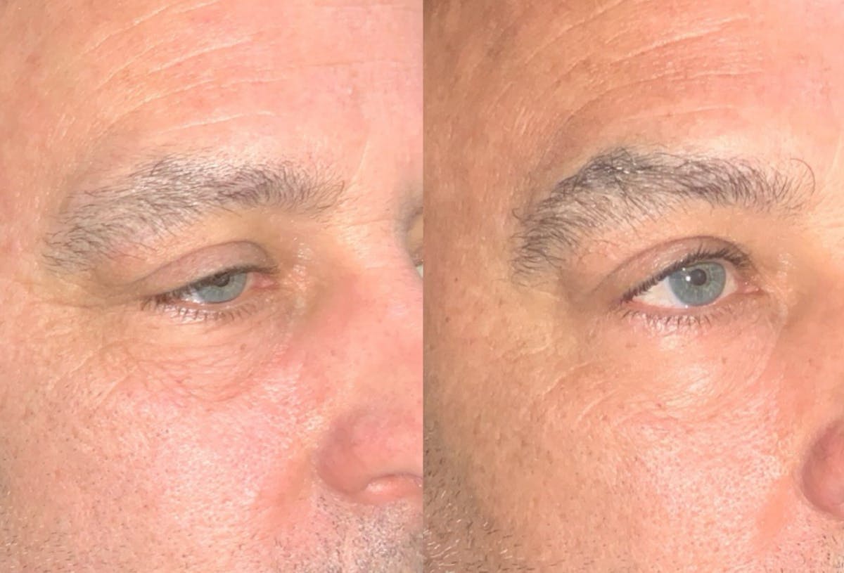 Face Before & After Gallery - Patient 322917 - Image 2