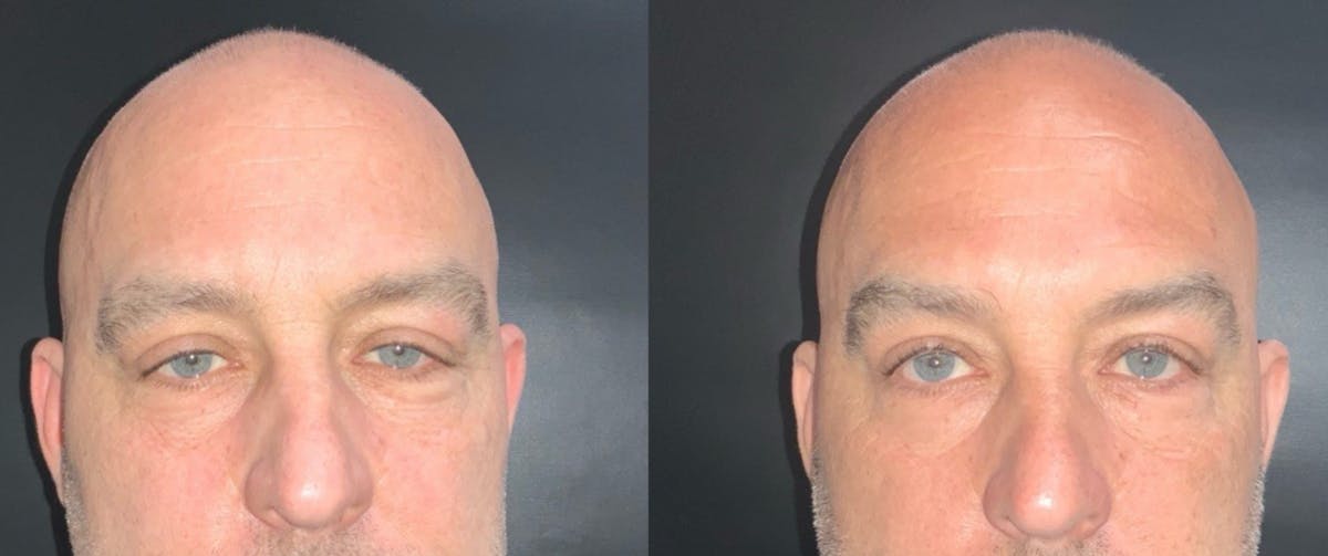 Face Before & After Gallery - Patient 322917 - Image 3
