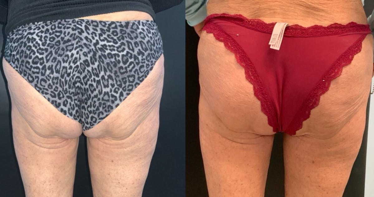 Body Before & After Gallery - Patient 430573 - Image 2