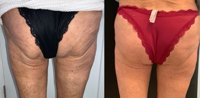 Body Before & After Gallery - Patient 430573 - Image 1