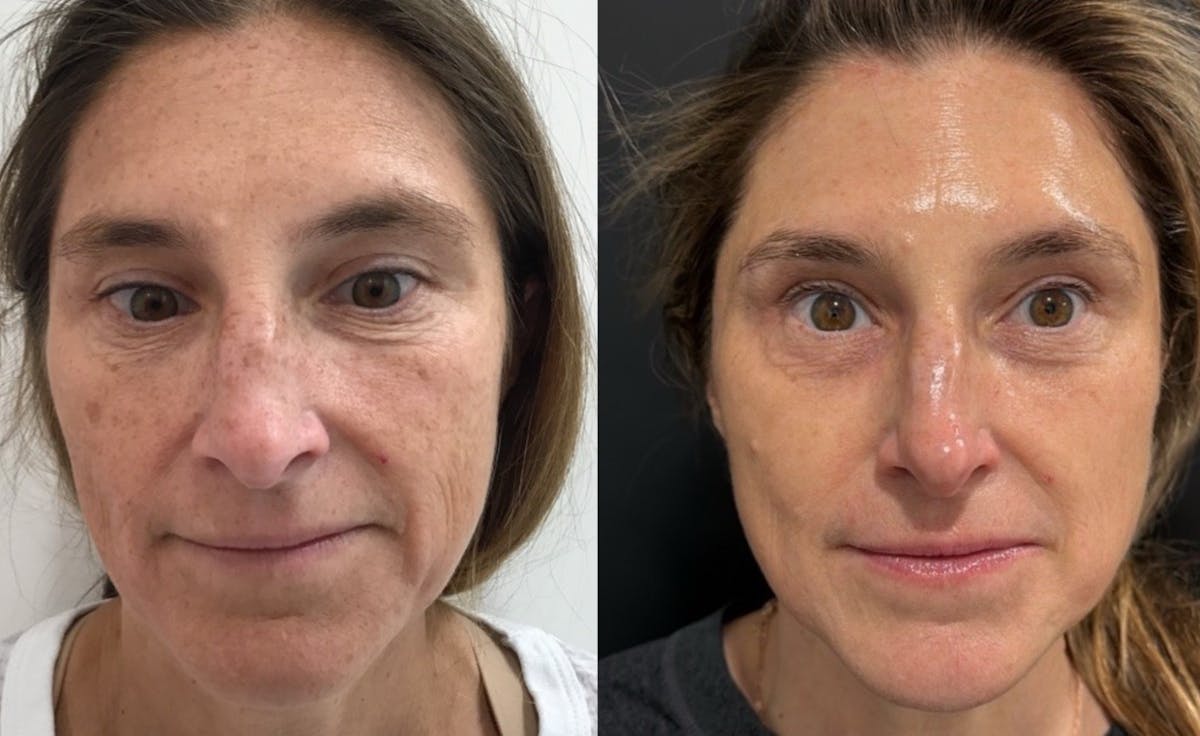 Face Before & After Gallery - Patient 125528 - Image 1