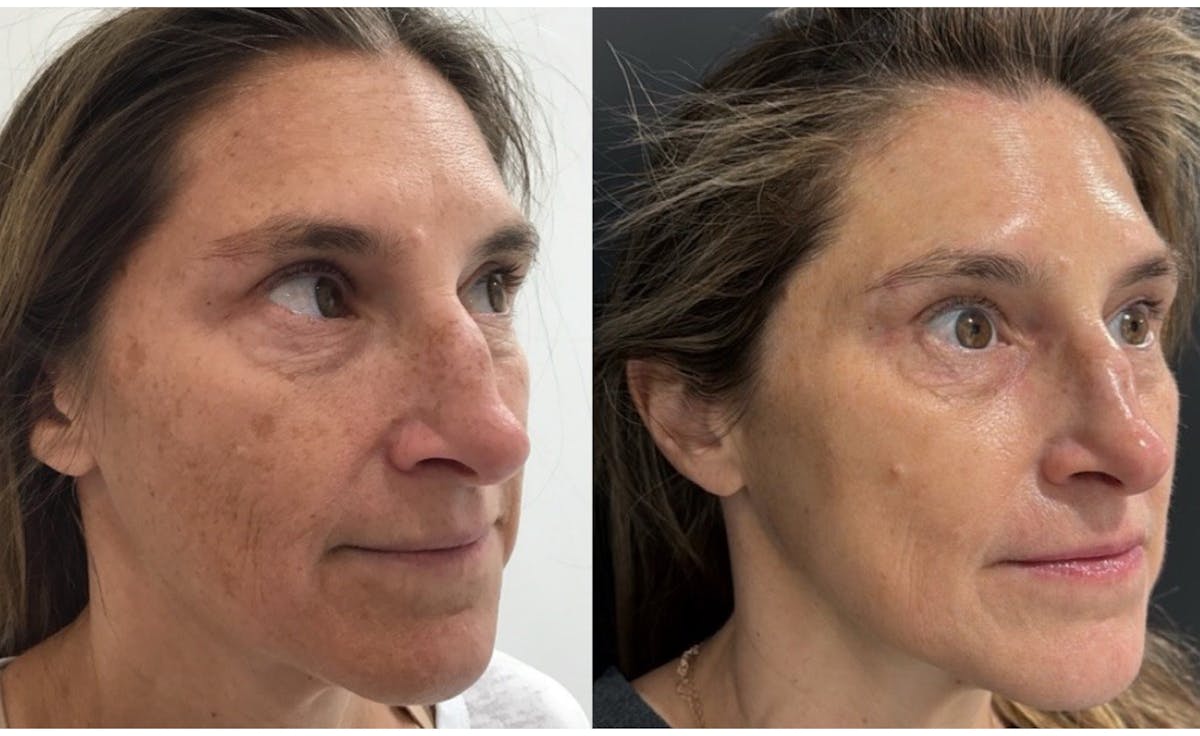 Face Before & After Gallery - Patient 125528 - Image 2
