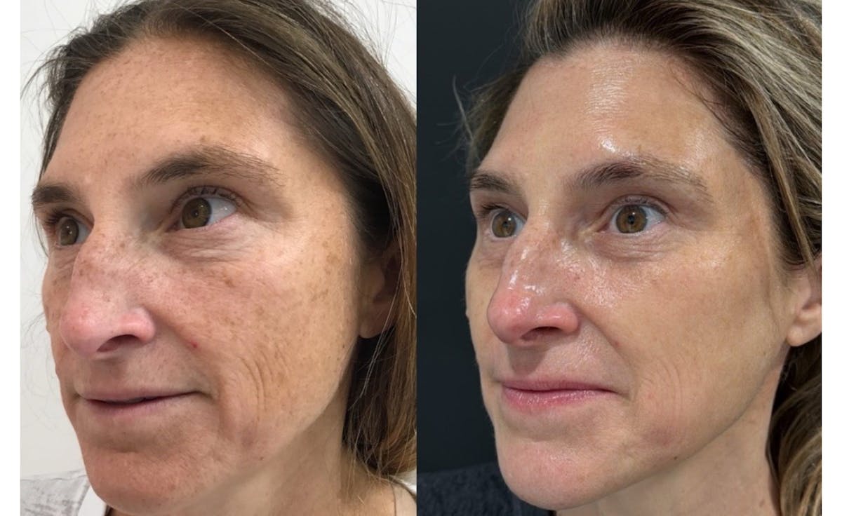 Face Before & After Gallery - Patient 125528 - Image 3