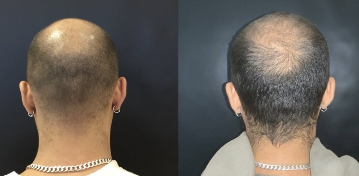 Hair Before & After Gallery - Patient 605002 - Image 1