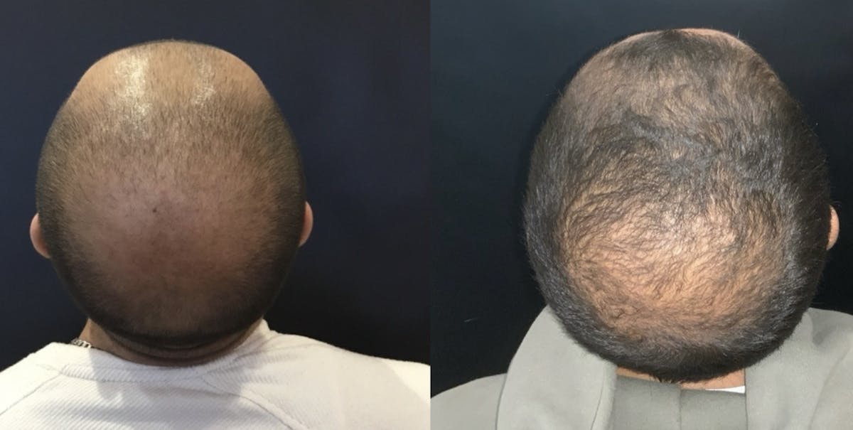 Hair Before & After Gallery - Patient 605002 - Image 4