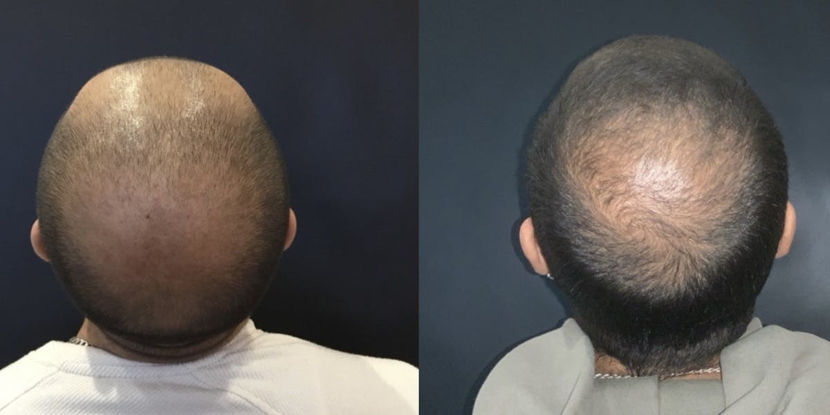 Hair Before & After Gallery - Patient 605002 - Image 5