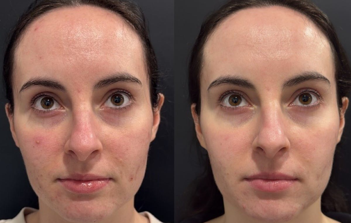 Face Before & After Gallery - Patient 401358 - Image 1