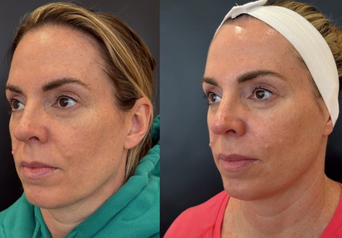 Face Before & After Gallery - Patient 266531 - Image 4
