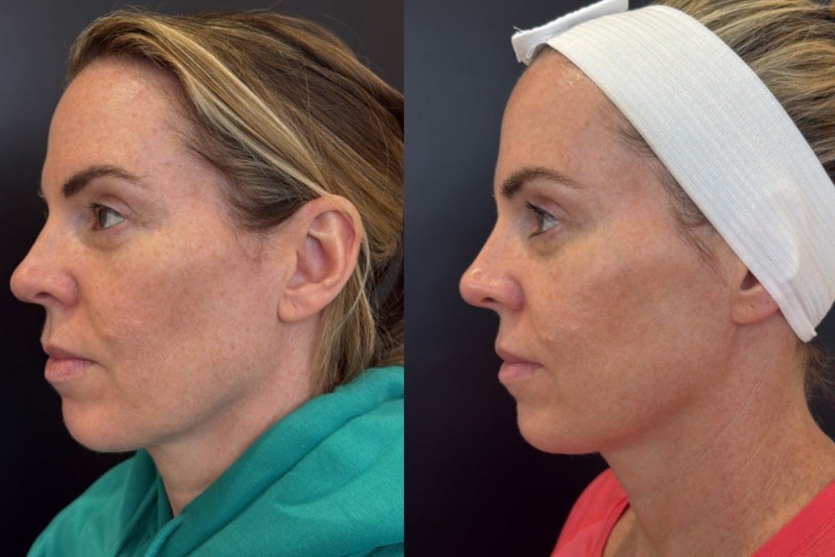 Face Before & After Gallery - Patient 266531 - Image 5