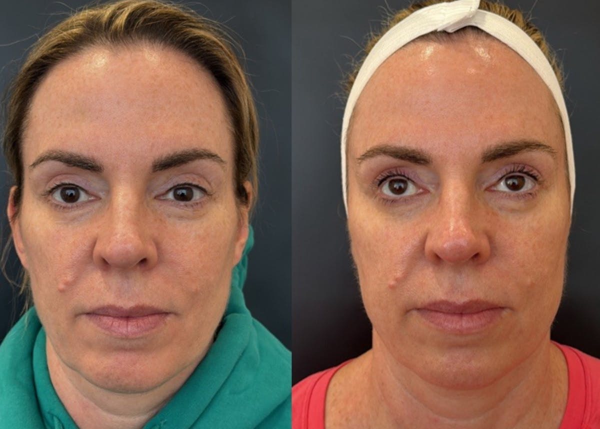 Face Before & After Gallery - Patient 266531 - Image 1