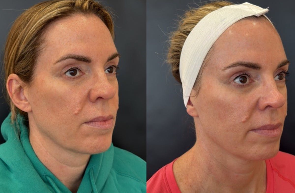 Face Before & After Gallery - Patient 266531 - Image 2