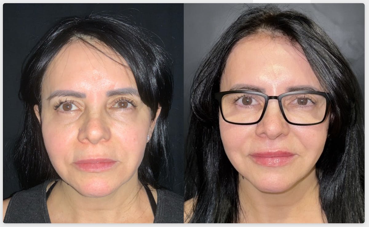 Face Before & After Gallery - Patient 418833 - Image 1