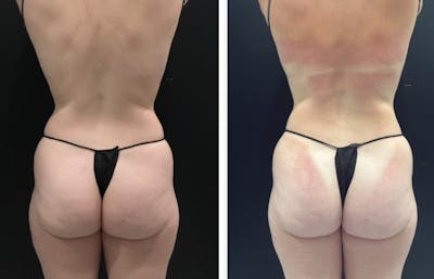 Buttocks Before & After Gallery - Patient 361905 - Image 1