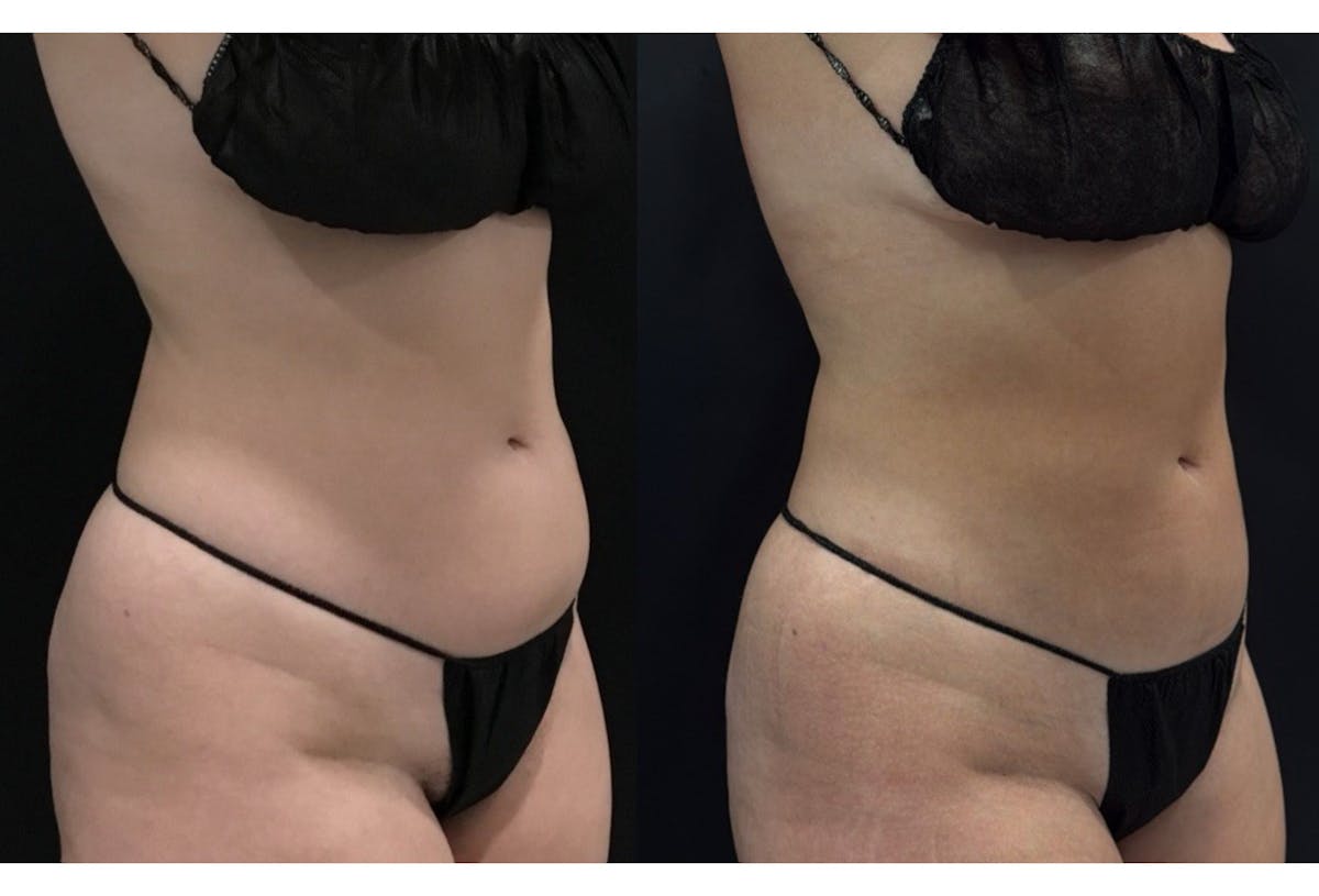 Buttocks Before & After Gallery - Patient 361905 - Image 5