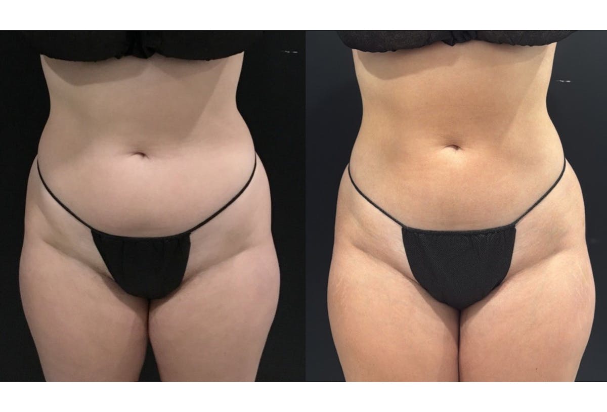 Buttocks Before & After Gallery - Patient 361905 - Image 4