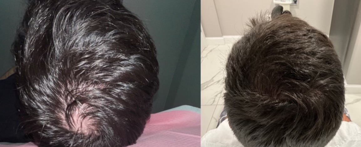 oral minoxidil and semaglutide Novel Hair Loss Solutions: Exosomes and Oral Minoxidil for Effective  Regrowth