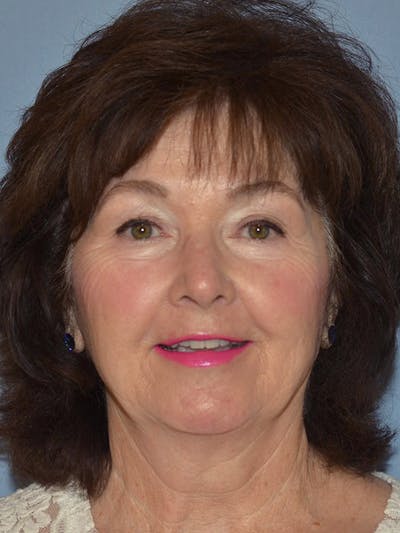 Complete Refreshed Makeovers Before & After Gallery - Patient 255906 - Image 1