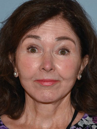 Complete Refreshed Makeovers Before & After Gallery - Patient 255906 - Image 2