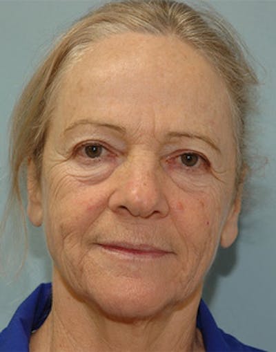 Complete Refreshed Makeovers Before & After Gallery - Patient 146094 - Image 1