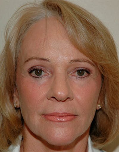 Complete Refreshed Makeovers Before & After Gallery - Patient 146094 - Image 2