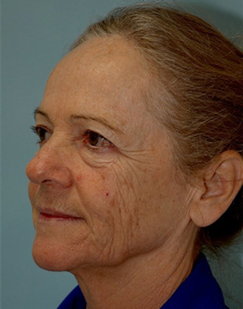 Complete Refreshed Makeovers Before & After Gallery - Patient 146094 - Image 3