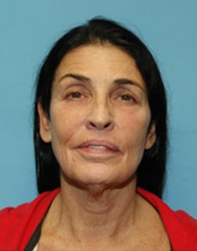 Complete Refreshed Makeovers Before & After Gallery - Patient 977212 - Image 1