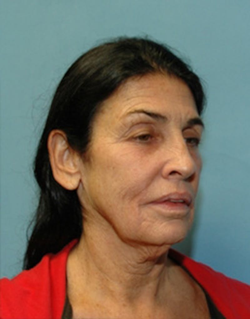 Complete Refreshed Makeovers Before & After Gallery - Patient 977212 - Image 3