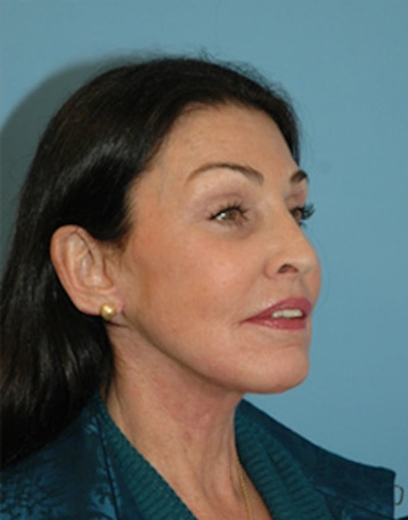 Complete Refreshed Makeovers Before & After Gallery - Patient 977212 - Image 4