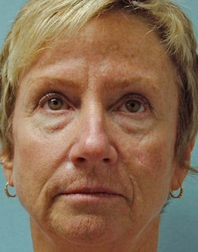 Complete Refreshed Makeovers Before & After Gallery - Patient 419935 - Image 1