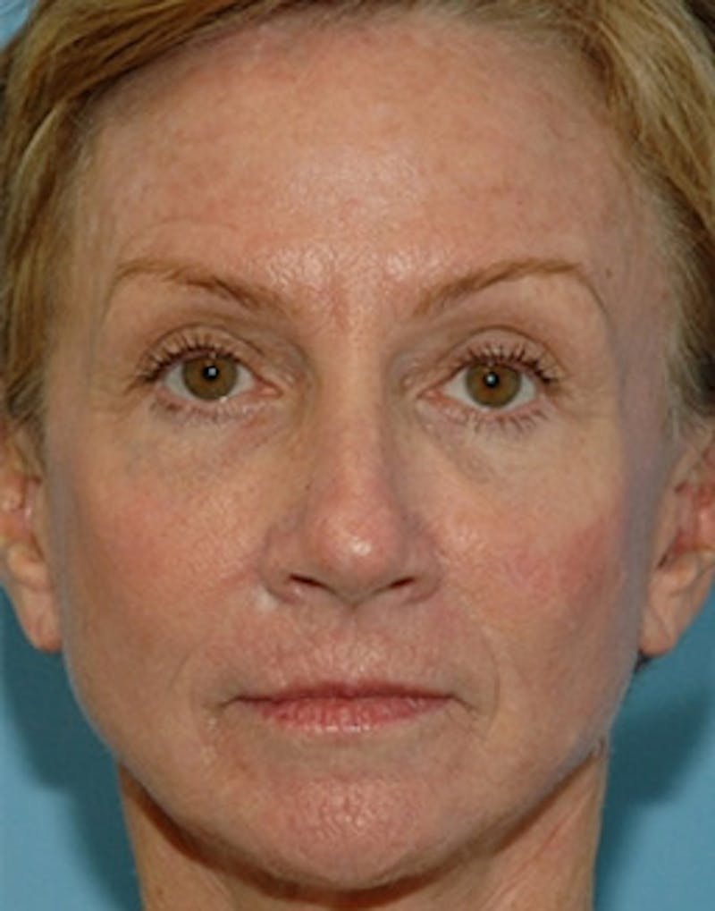 Complete Refreshed Makeovers Before & After Gallery - Patient 419935 - Image 2
