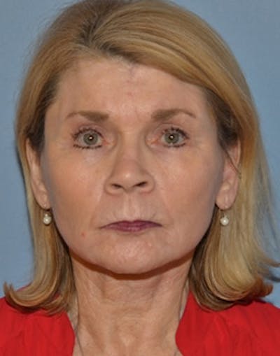 Complete Refreshed Makeovers Before & After Gallery - Patient 190736 - Image 2
