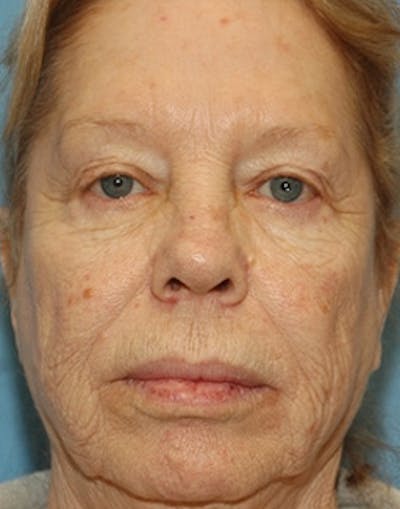 Complete Refreshed Makeovers Before & After Gallery - Patient 316392 - Image 1