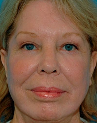 Complete Refreshed Makeovers Before & After Gallery - Patient 316392 - Image 2