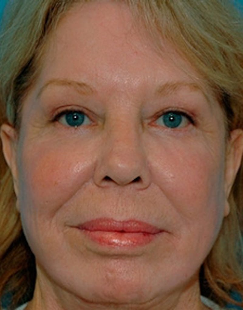 Complete Refreshed Makeovers Before & After Gallery - Patient 316392 - Image 2