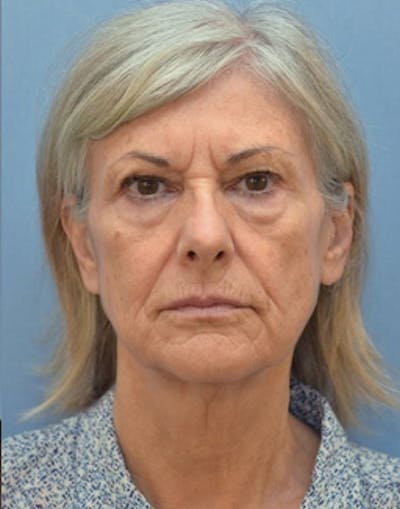 Complete Refreshed Makeovers Before & After Gallery - Patient 164820 - Image 1