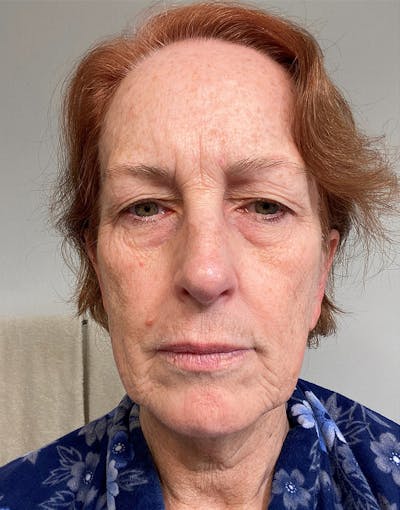 Complete Refreshed Makeovers Before & After Gallery - Patient 598239 - Image 1