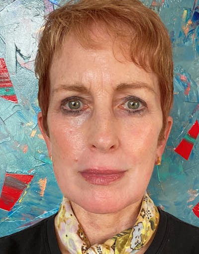 Complete Refreshed Makeovers Before & After Gallery - Patient 598239 - Image 2