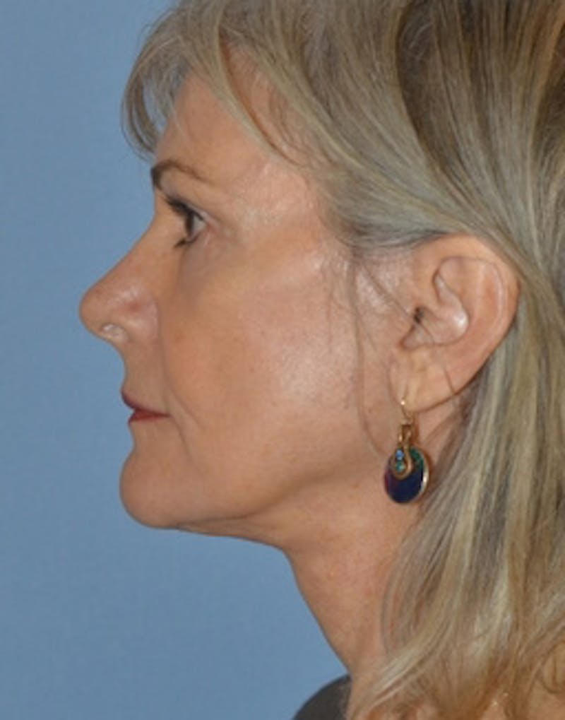 Lower Face & Neck Lift Before & After Gallery - Patient 301269 - Image 4