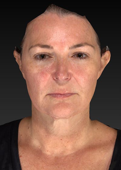 Lower Face & Neck Lift Before & After Gallery - Patient 423170 - Image 1