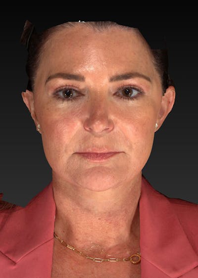 Lower Face & Neck Lift Before & After Gallery - Patient 423170 - Image 2